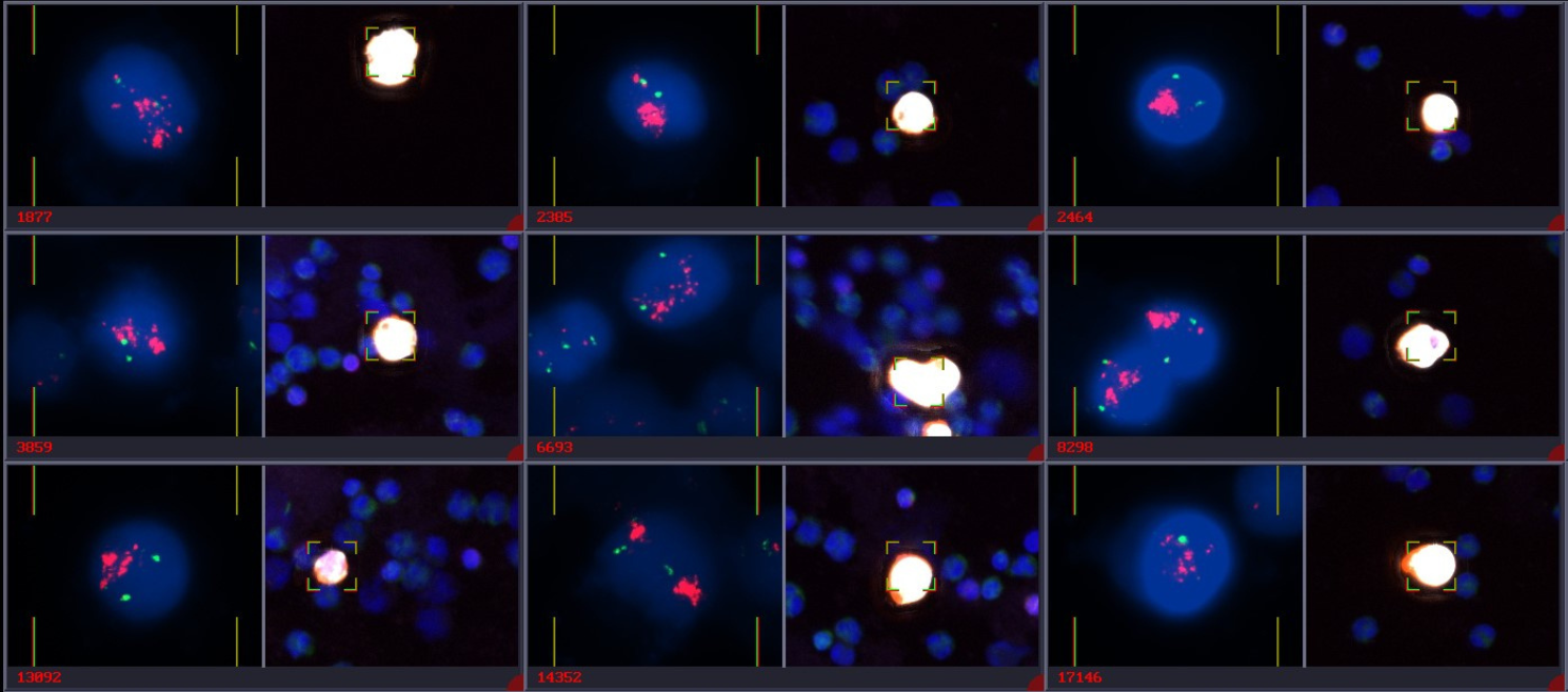 Rare cells identified in the peripheral blood were consecutively hybridized with FISH probes.