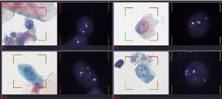 Cytology samples consecutively stained with Papanicolaou and FISH probes.